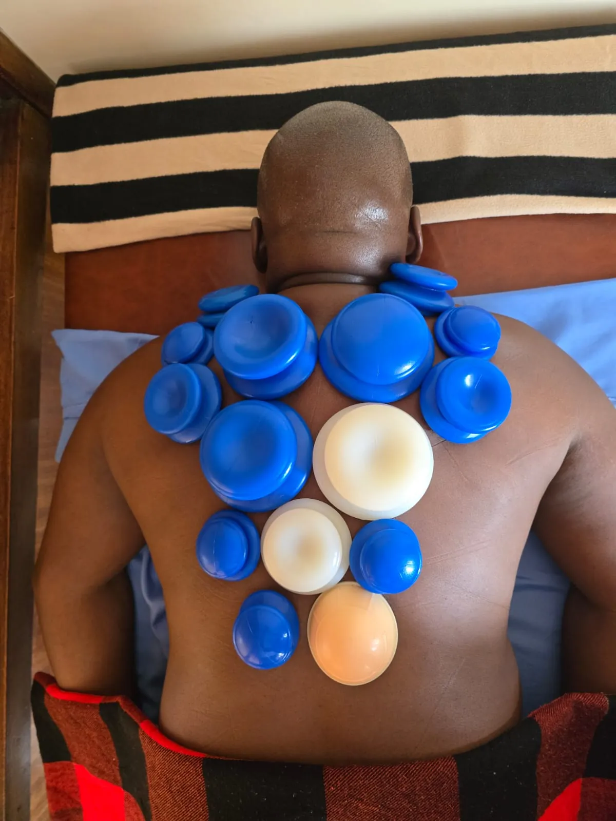 Cupping therapy applied across the back