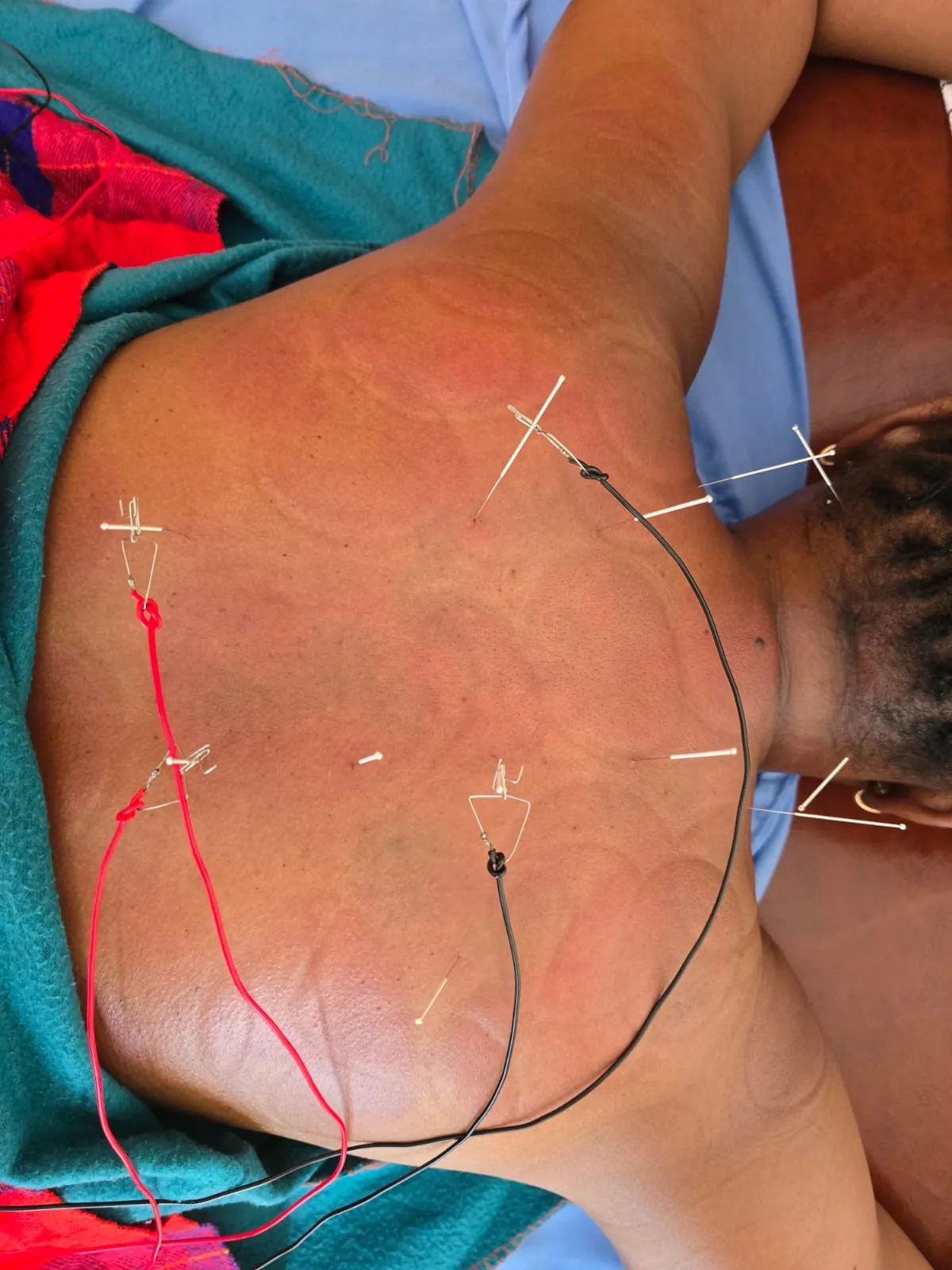 Electro-acupuncture treatment for natural pain relief